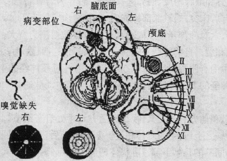 第八節(jié) 顱底及腦底結(jié)構(gòu)及其病變綜合征
